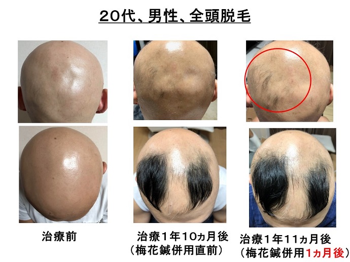 円形脱毛症　病院